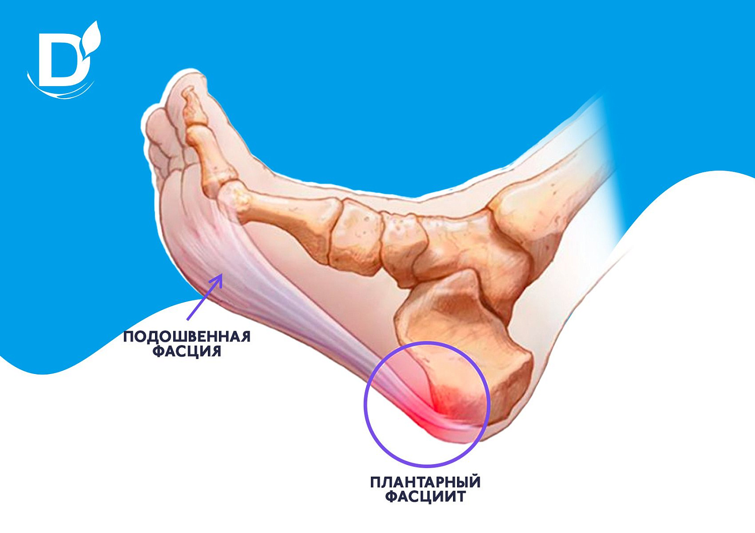 Что нужно знать про пяточные шпоры?